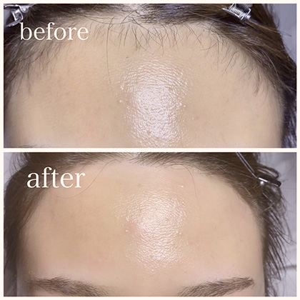 Example of threading (hair removal from forehead) treatment